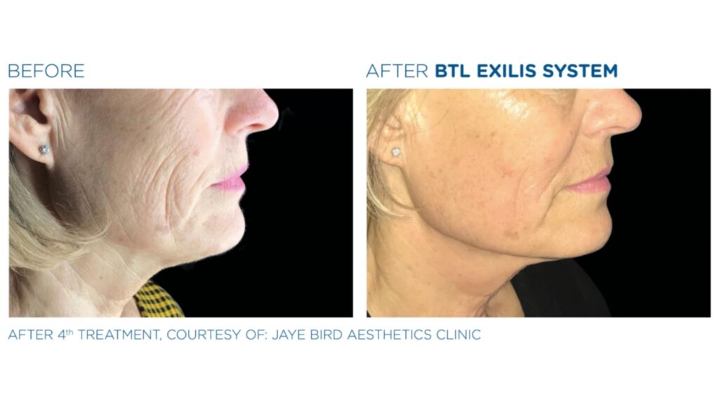 BTL Exilis treatment cheshire