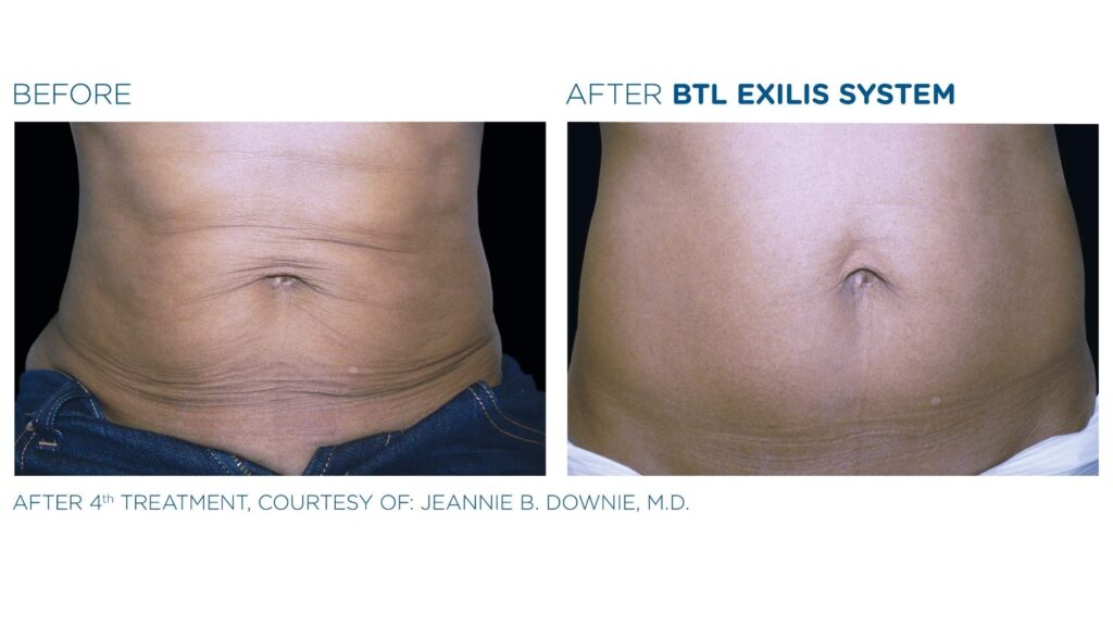 stomach tightening treatment cheshire